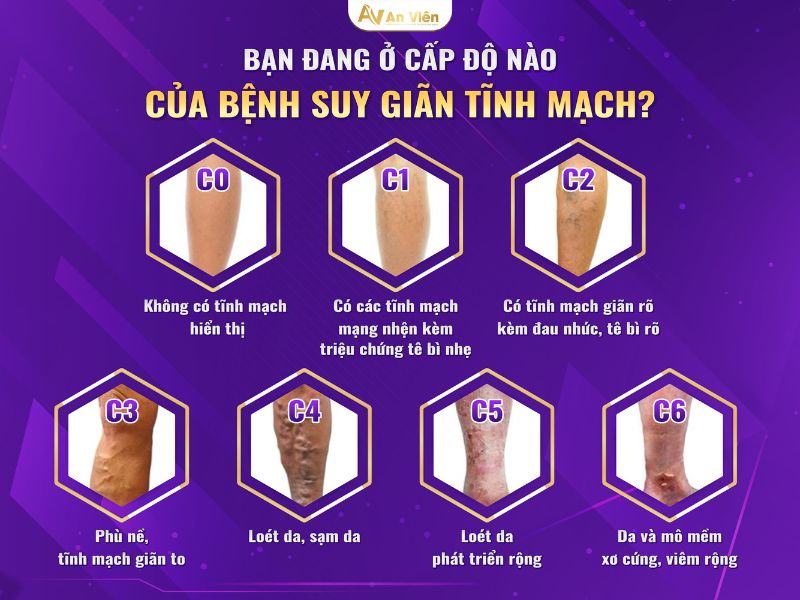 biểu hiện suy giãn tĩnh mạch 