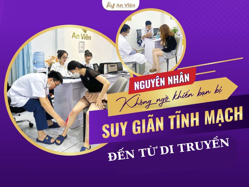 cách làm giảm suy giãn tĩnh mạch