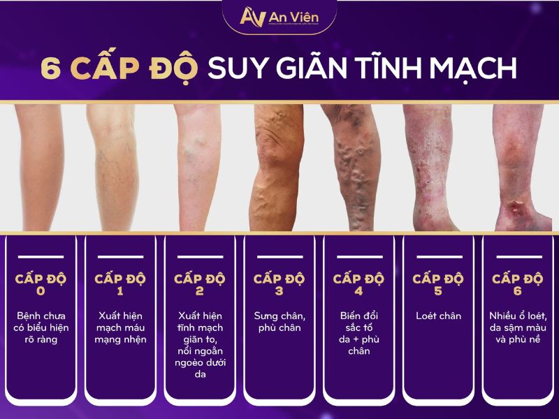 đau giãn tĩnh mạch chân