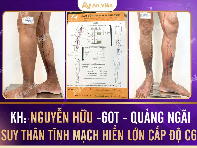 đau giãn tĩnh mạch chân