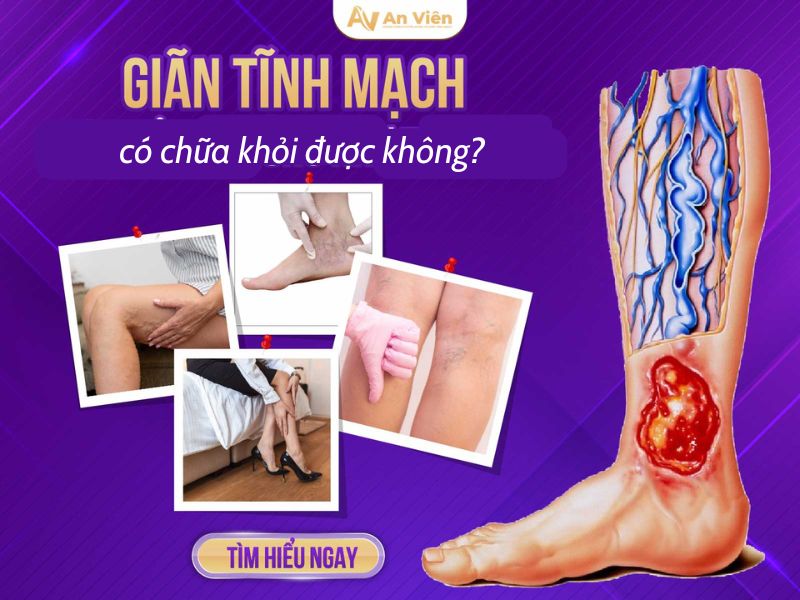 giãn tĩnh mạch có trị hết không