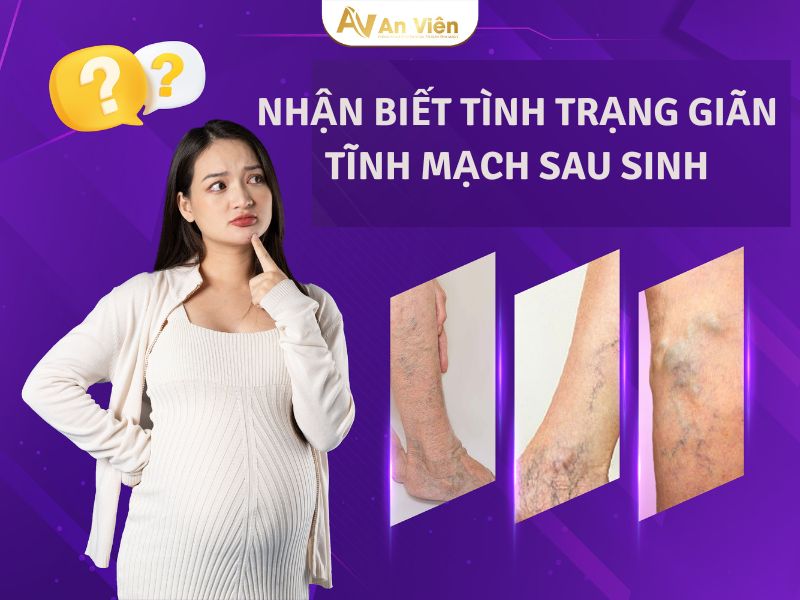 giãn tĩnh mạch sau sinh