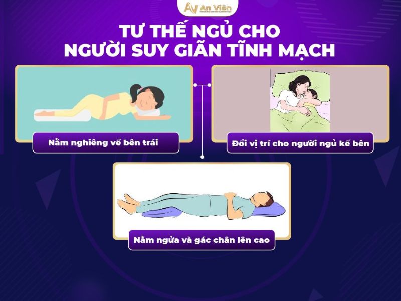 giãn tĩnh mạch sau sinh