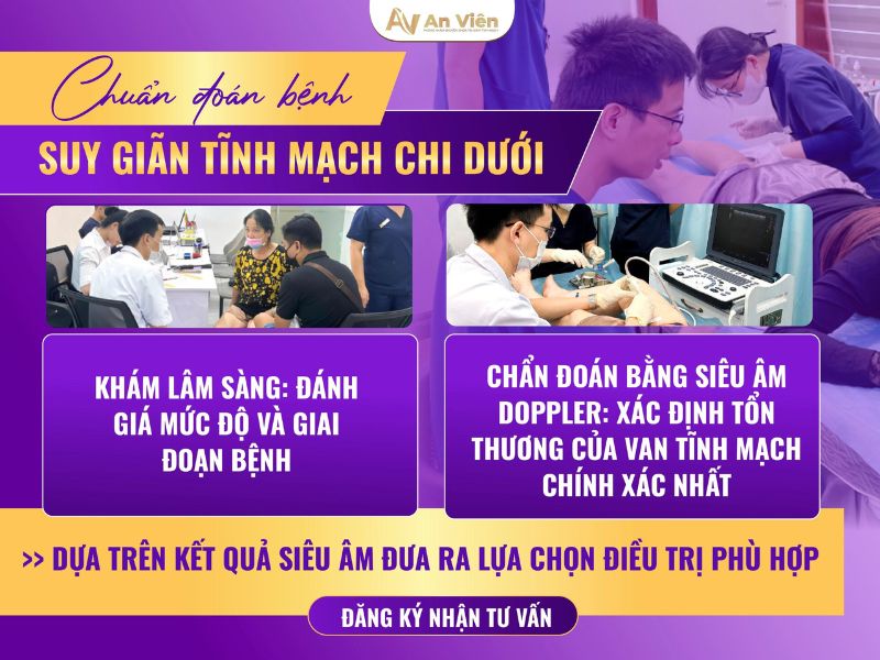 hình ảnh giãn tĩnh mạch chi dưới