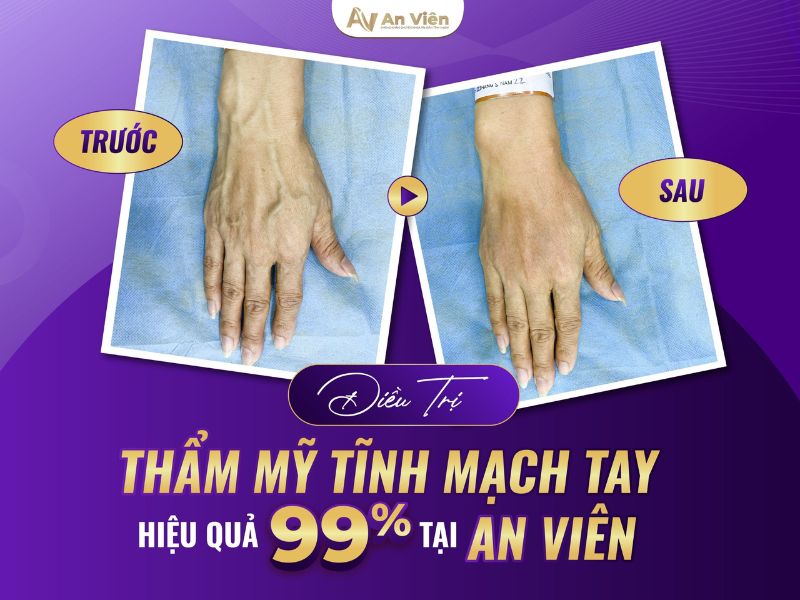 nổi tĩnh mạch ở tay