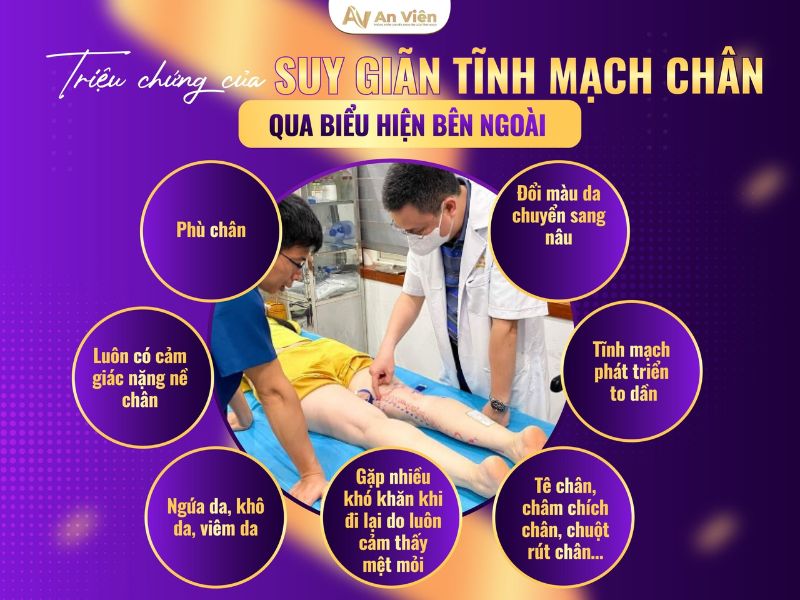 phình mạch máu ở chân