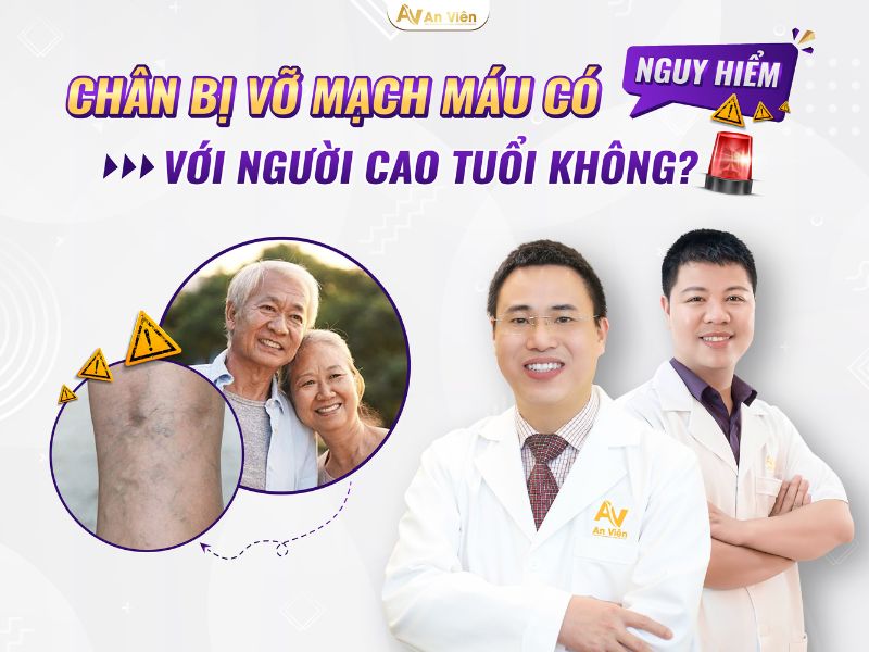 phòng suy giãn tĩnh mạch chân