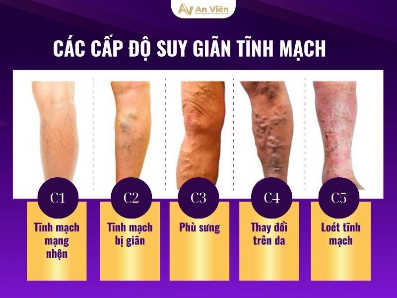 suy giảm tĩnh mạch chi dưới