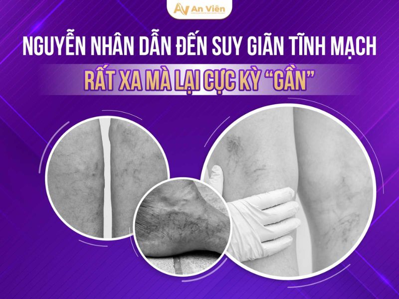 suy giãn tĩnh mạch chi dưới có nguy hiểm không