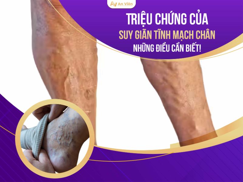 suy giãn tĩnh mạch chi dưới có nguy hiểm không