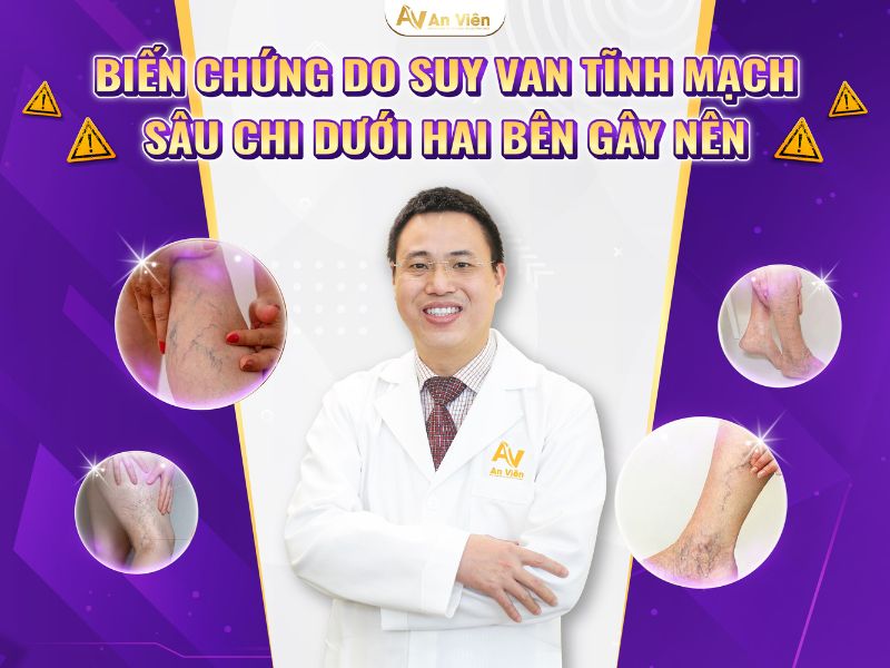 suy tĩnh mạch sâu là gì