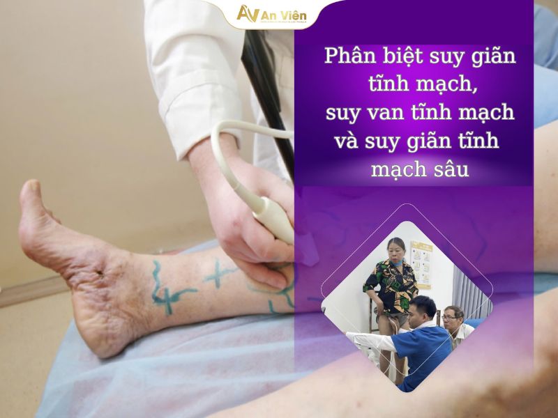 suy tĩnh mạch sâu là gì
