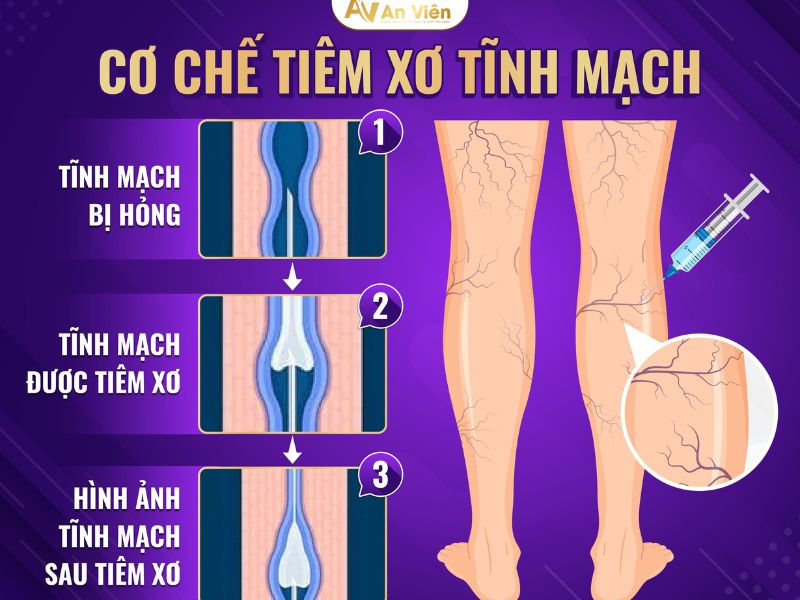 tiêm xơ tĩnh mạch là gì