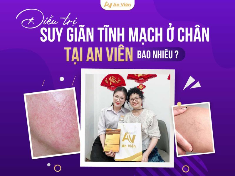 tiêm xơ tĩnh mạch là gì