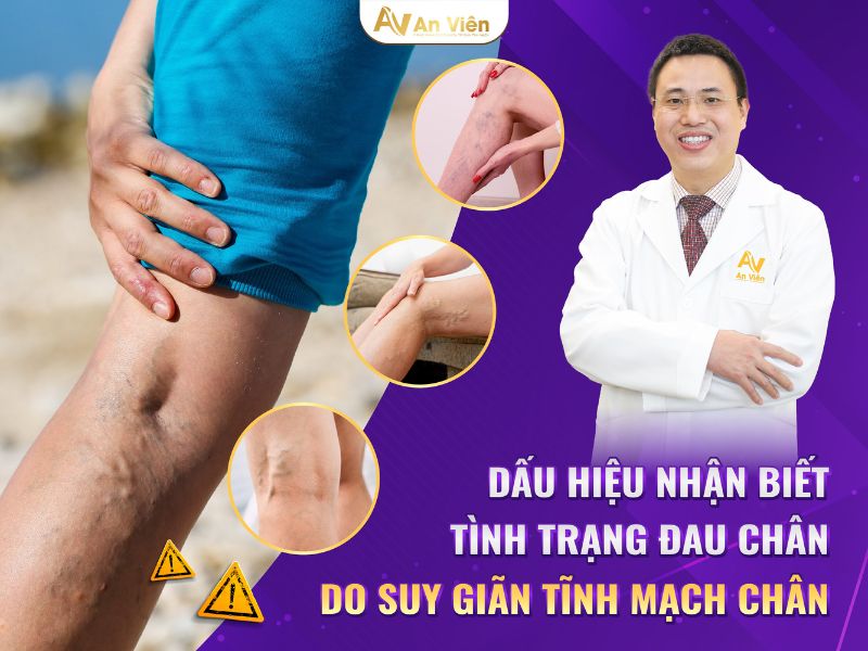 triệu chứng suy tĩnh mạch chi dưới