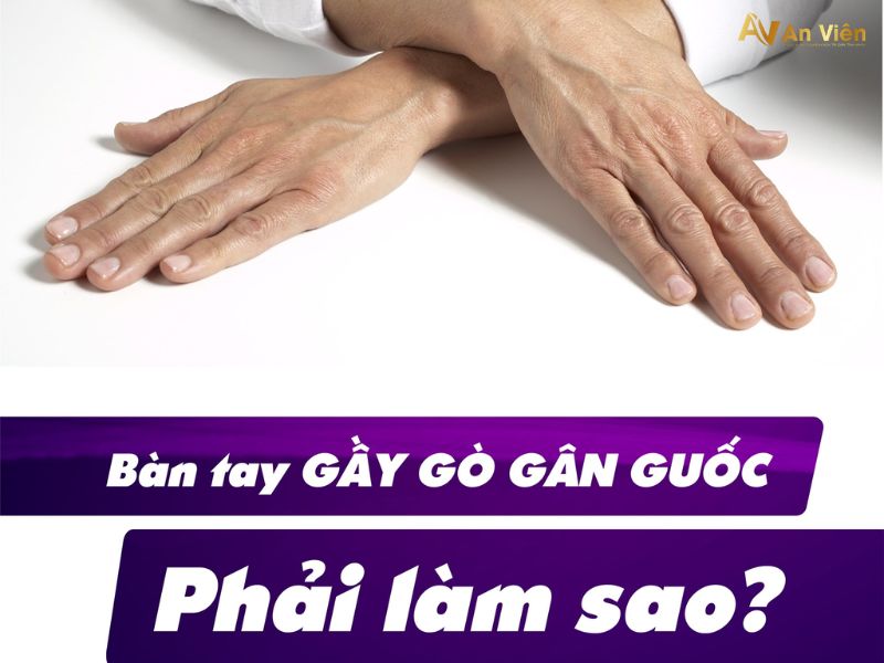 viêm tắc tĩnh mạch tay