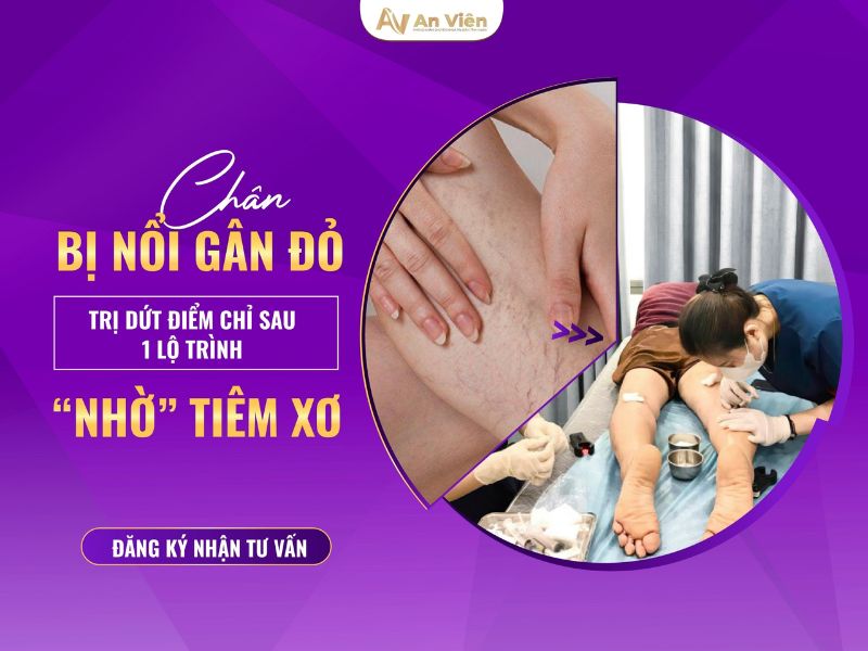 chân nổi nhiều mạch máu nhỏ
