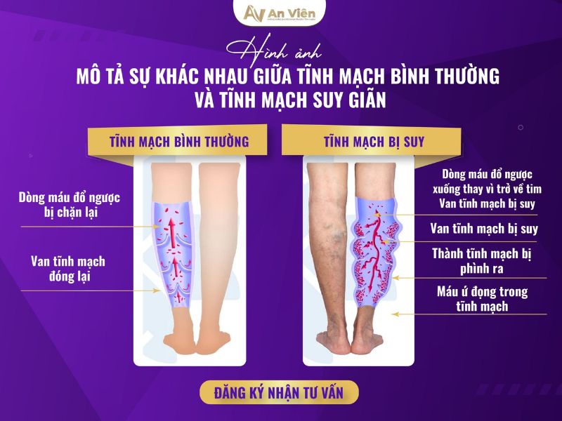 bàn chân bị giãn tĩnh mạch