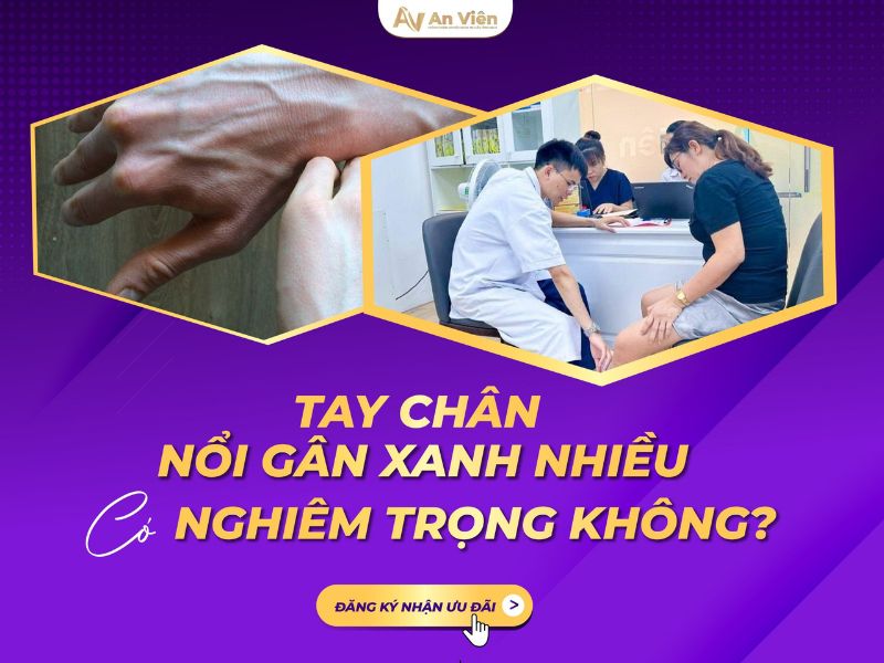 bàn chân bị giãn tĩnh mạch