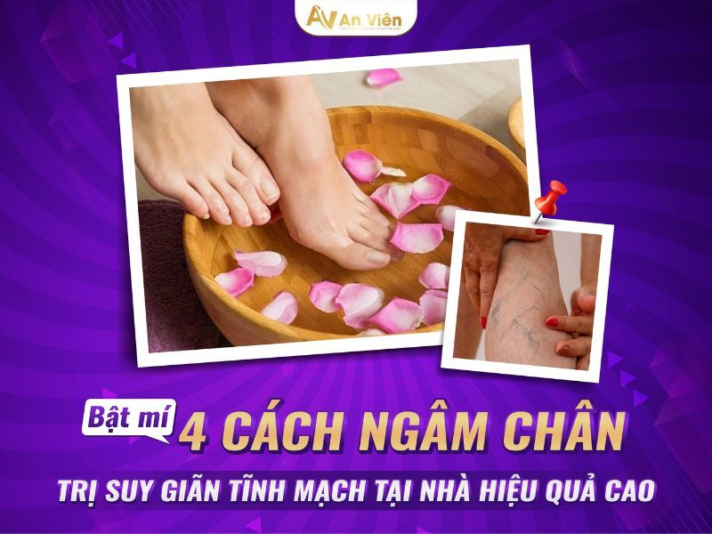 bàn chân bị giãn tĩnh mạch
