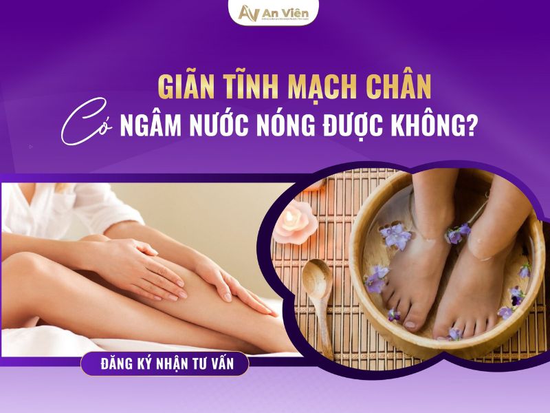 bàn chân bị giãn tĩnh mạch