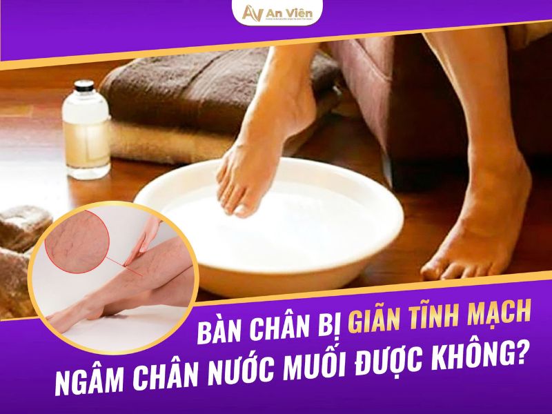 bàn chân bị giãn tĩnh mạch