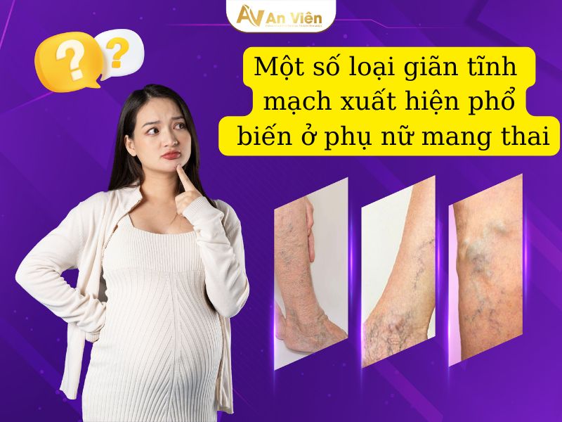 bầu giãn tĩnh mạch