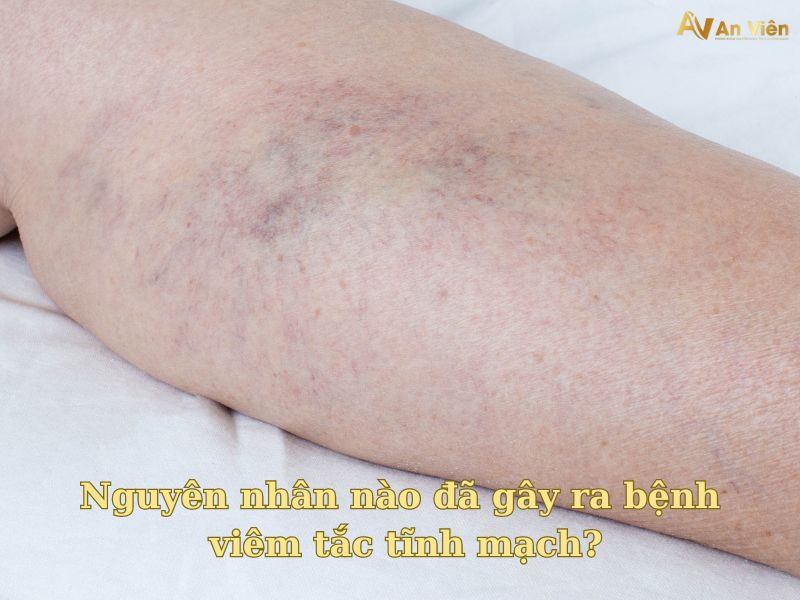 bệnh viêm tắc tĩnh mạch