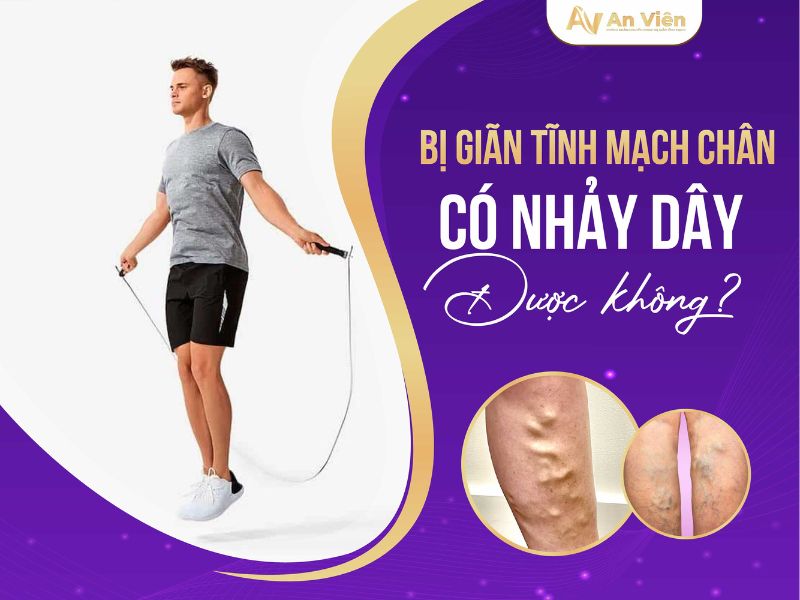 bị giãn tĩnh mạch chân có nhảy dây được không