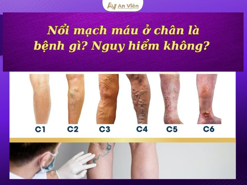 bị nổi mạch máu đỏ dưới da chân