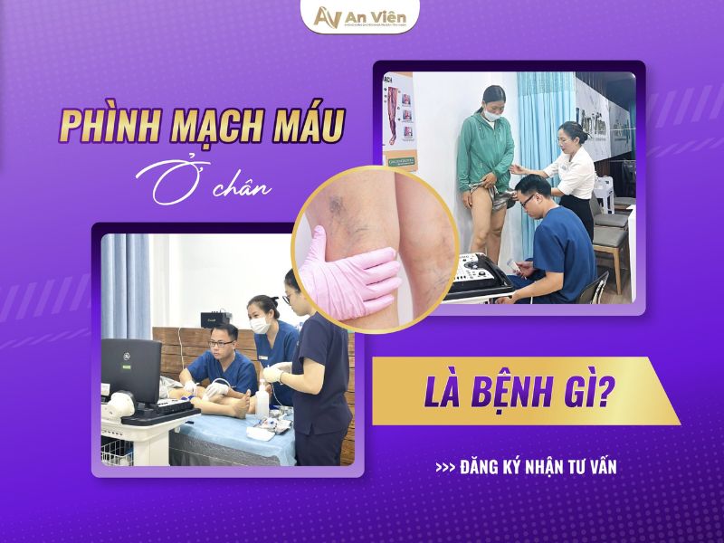 biểu hiện của bệnh giãn tĩnh mạch chân