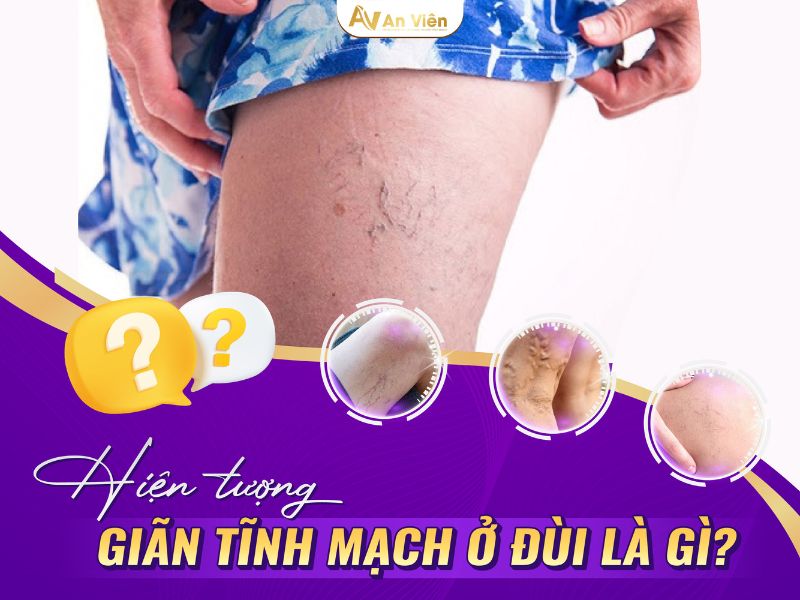 cách nhận biết giãn tĩnh mạch chân
