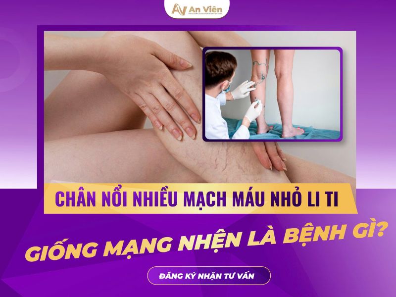 cách nhận biết giãn tĩnh mạch chân