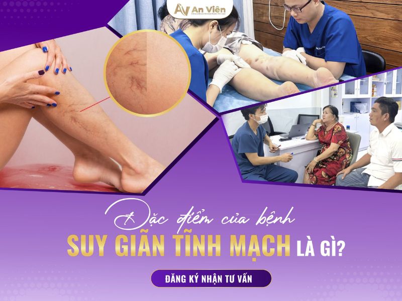 cách nhận biết giãn tĩnh mạch chân