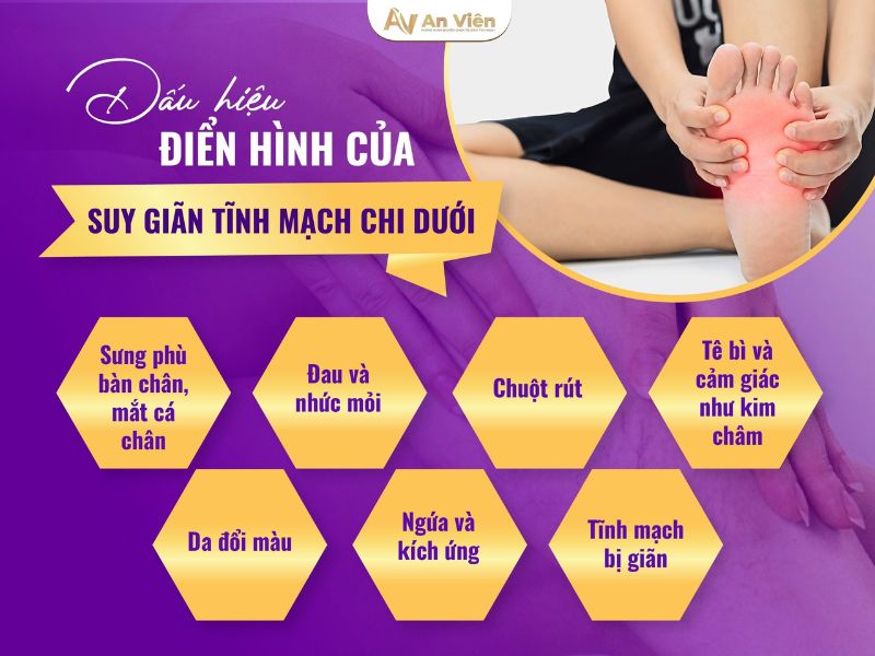 cách phòng chống suy giãn tĩnh mạch