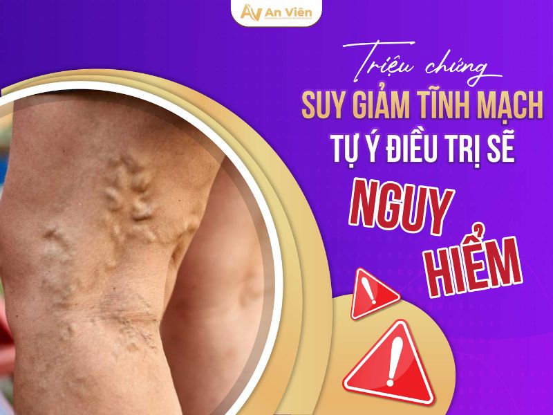 cách phòng ngừa giãn tĩnh mạch chân