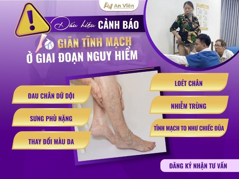 giãn tĩnh mạch ở chân có nguy hiểm không