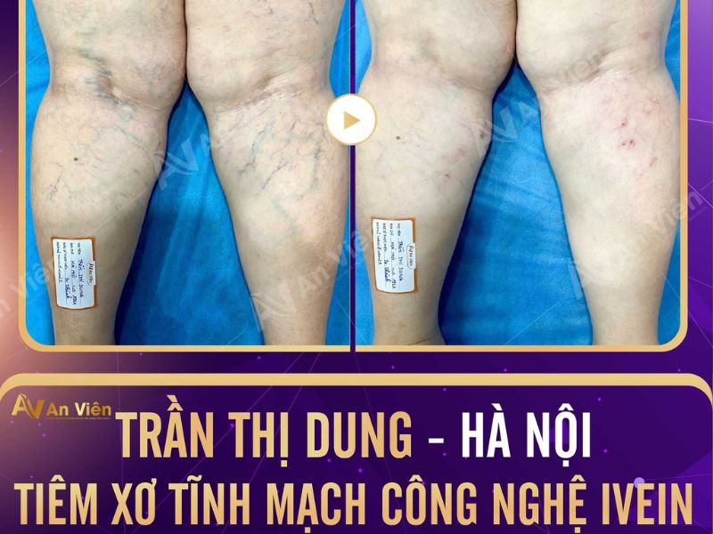 giãn tĩnh mạch ở chân có nguy hiểm không