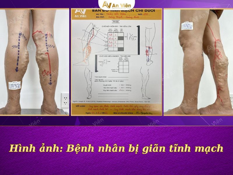 giãn tĩnh mạch ở chân có nguy hiểm không