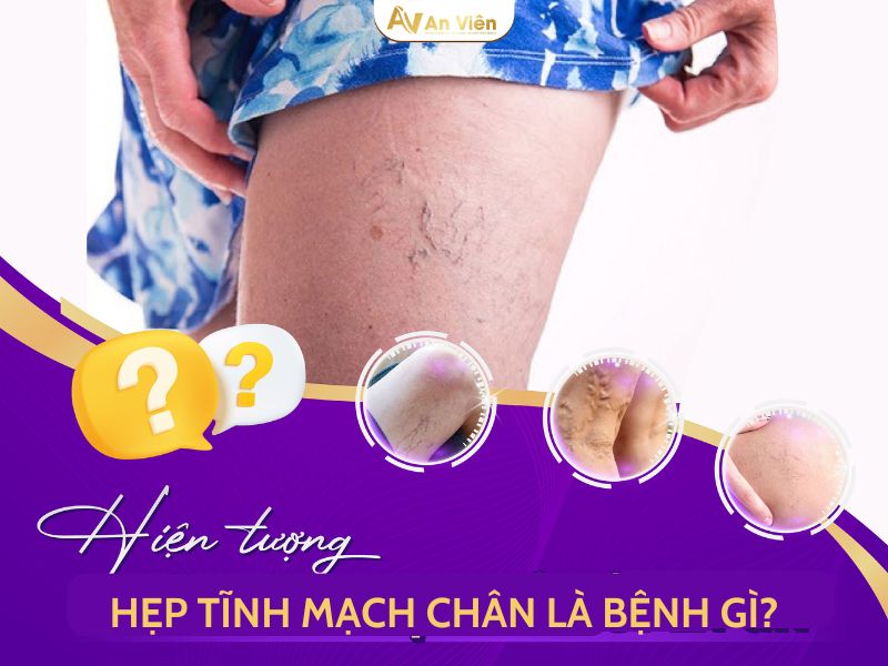 hẹp tĩnh mạch chân