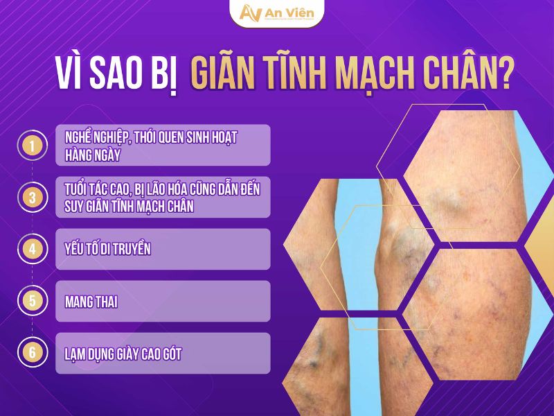 hẹp tĩnh mạch chân
