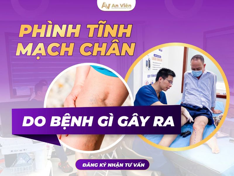 phình tĩnh mạch chân