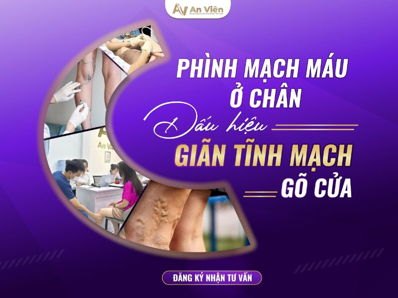 phình tĩnh mạch chân
