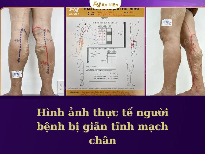 phình tĩnh mạch chân