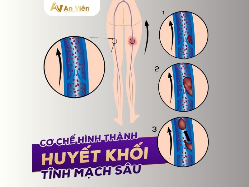 phình tĩnh mạch chân
