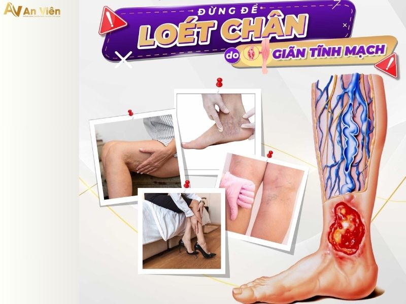 phình tĩnh mạch chân