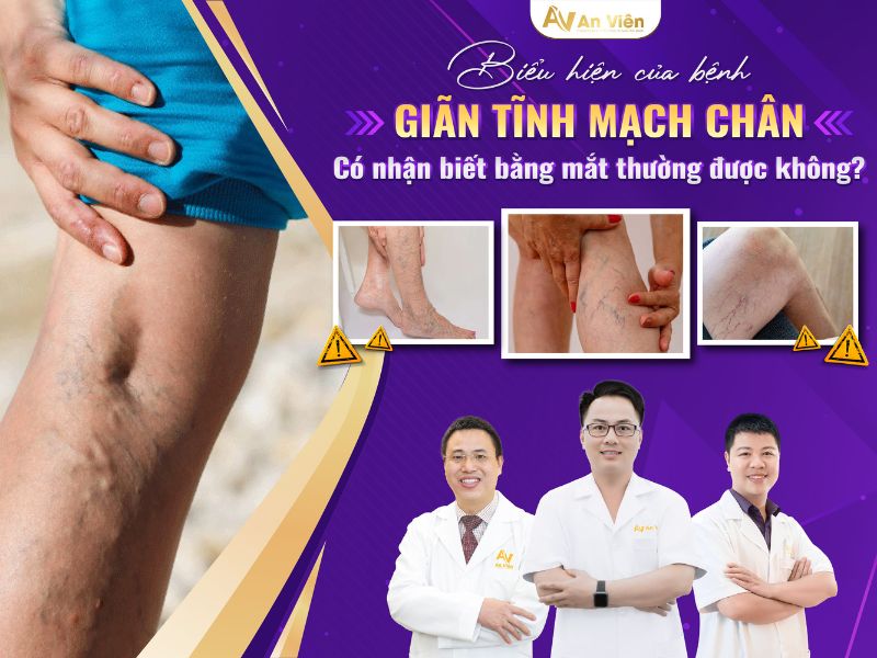 bệnh tĩnh mạch là gì