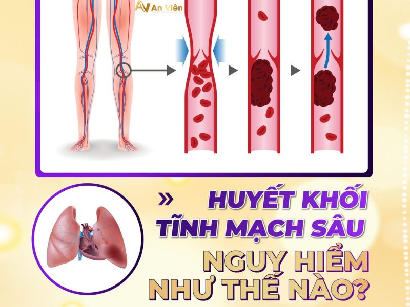bệnh tĩnh mạch là gì