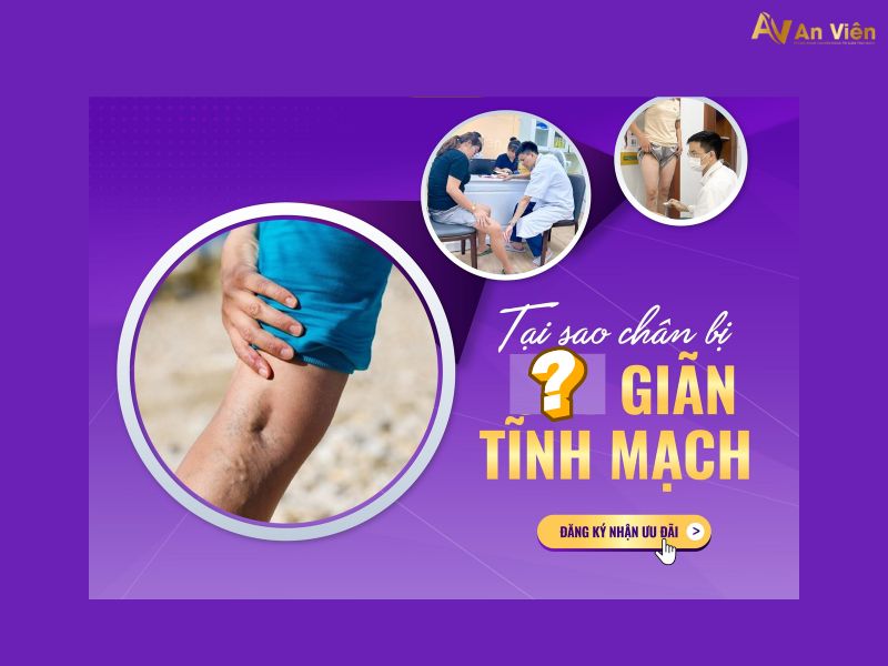 cách phòng ngừa giãn tĩnh mạch