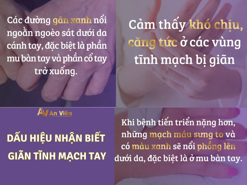 dấu hiệu giãn tĩnh mạch tay